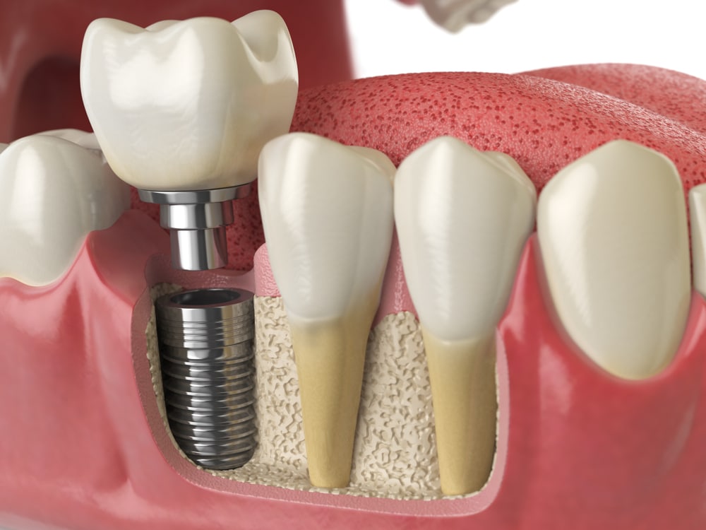 Restorative Dentistry complete dental care dentist in Spokane, WA and Kellogg, ID Anatomy,Of,Healthy,Teeth,And,Tooth,Dental,Implant,In,Human
